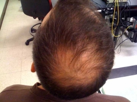 Alopecia.jpg
