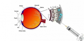 Primera-protesis.retina-liquida-del-mundo.jpg