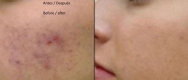 Limpieza-facial-eliminar-arrugas-y-cicatrices.jpg
