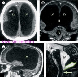Vivir-sin-cerebro.jpg