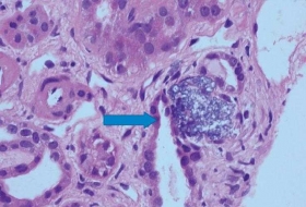 vitamina-D-puede-conducir-a-insuficiencia-renal.jpg