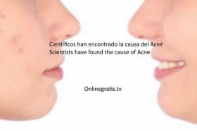 causa-del-Acne.jpg