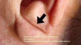 lobulo-de-la-oreja-arrugada.jpg